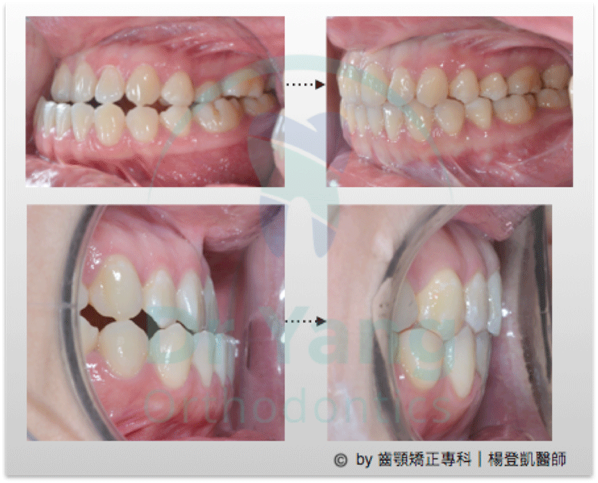 戽斗矯正 楊登凱