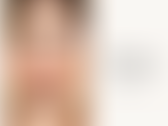 woman's skin after dermal fillers coventry