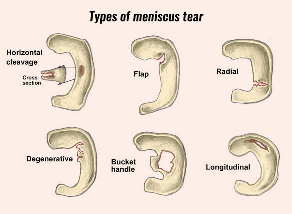 Meniscus Injury Types: A Complete Guide by Physio360