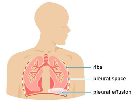 Pleural Effusion in Sports Population.