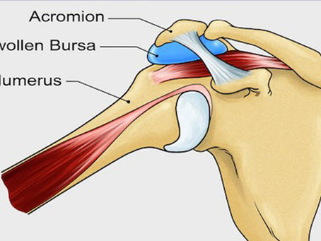 Shoulder Bursitis – Best Physiotherapy Treatment in Chennai | Physio360.