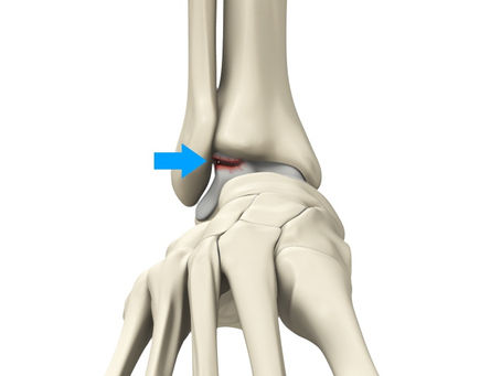 Osteochondral Lesion of the Talus – Causes, Symptoms, Diagnosis & Best Physiotherapy Treatment.