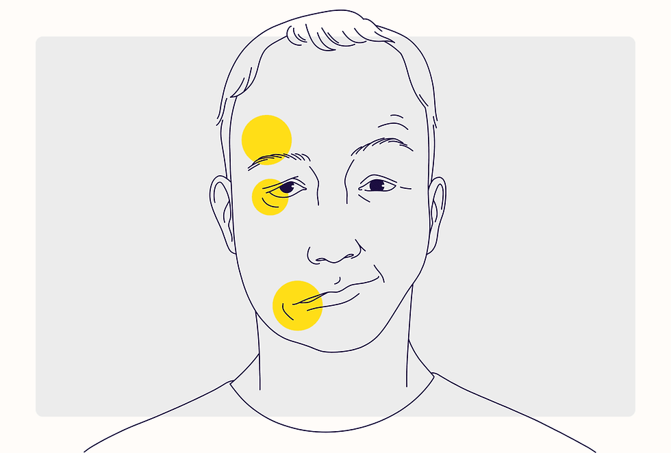 Facial Palsy – Causes, Symptoms, and Physiotherapy Management at Physio360 Chennai.