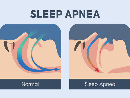 Sleep Apnea: Causes, Symptoms, Diagnosis & Physiotherapy Management | Physio360 Chennai.