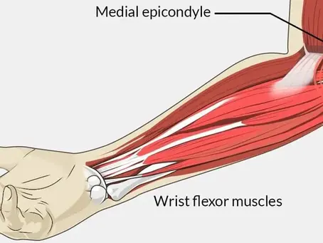 Golfer’s Elbow (Medial Epicondylitis): Causes, Symptoms & Best Physiotherapy Treatment at Physio360.