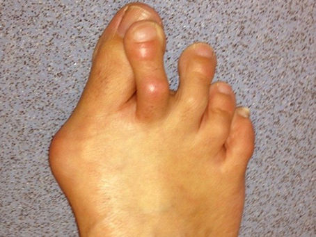 Overlap Toes – Causes, Symptoms, Treatment & Best Physiotherapy Management.