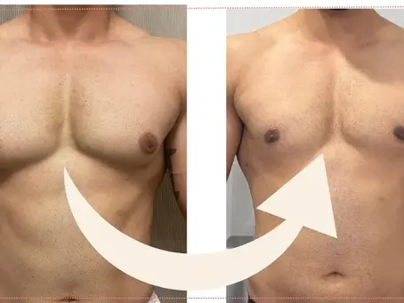 Post-Surgical Gynecomastia Rehabilitation: Why Physiotherapy Is Essential for Faster & Safer Recovery Physio360
