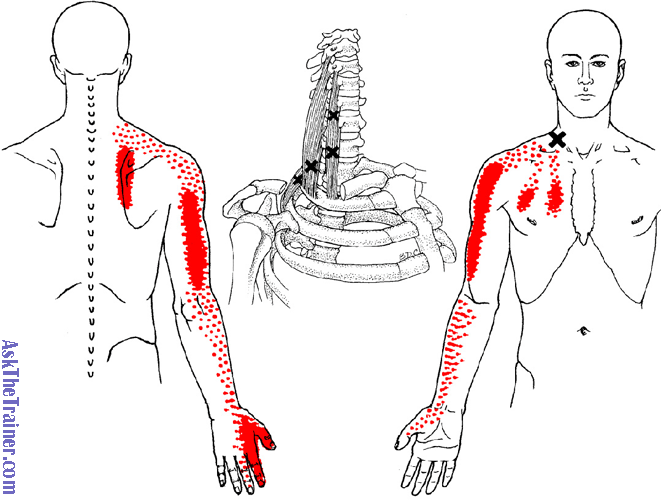 First Rib Syndrome: Hidden Cause of Neck, Shoulder & Arm Pain ...