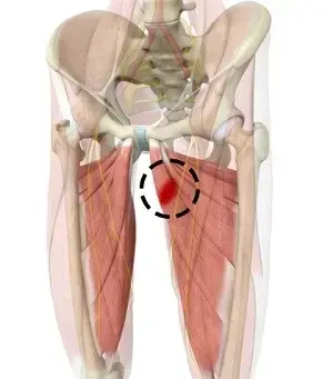 Groin Injury – Causes, Symptoms, Treatment & Physiotherapy Management at Physio360 Chennai