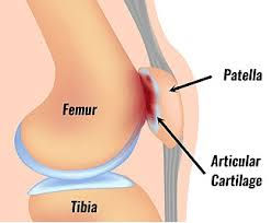 Patellofemoral Joint Stress – Causes, Symptoms, Physiotherapy Treatment & Fast Recovery.