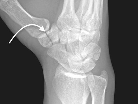 Trapezium Fracture: Causes, Symptoms, Diagnosis & Physiotherapy Management.