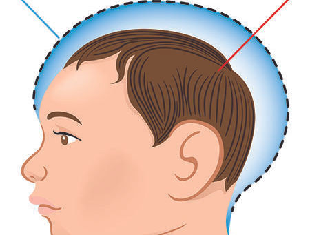 MICROCEPHALY – A COMPREHENSIVE GUIDE By Physio360 – Best Physiotherapy & Neuro Rehab in Chennai