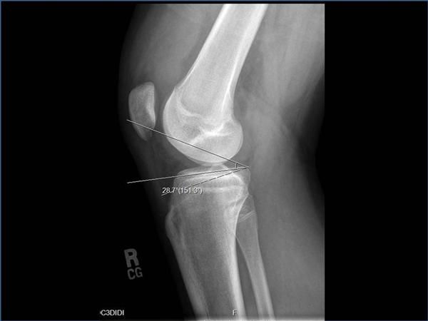 Patella Instability in Sports – Causes, Symptoms, Treatment & Physiotherapy Management.