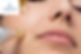 Microneedling at Lady May Aesthetics Skin Clinic
