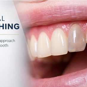 🦷 Blanchiment interne : la solution pour les dents dévitalisées qui ont noirci