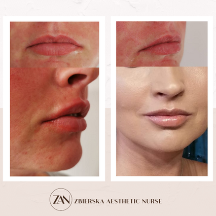 zbierska aesthetic nurse lips filler before and after tadworth gardens ..png