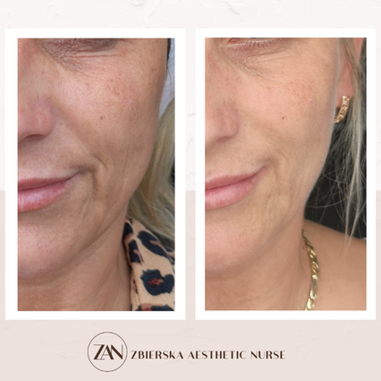zbierska aesthetic nurse face contouring cheek filler vampire face lift before and after t