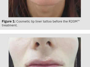 Laser Cosmetic Tattoo Removal Successful After One Session of R20M™ Method: A Case Study Report