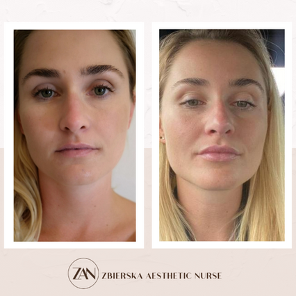 zbierska aesthetic nurse lips filler before and after tadworth gardens ....png