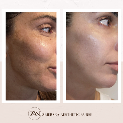 zbierska aesthetic nurse vampire face lift combine treatment before and after tadworth gar