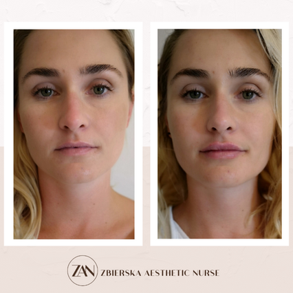 zbierska aesthetic nurse lips filler before and after tadworth gardens ,.png