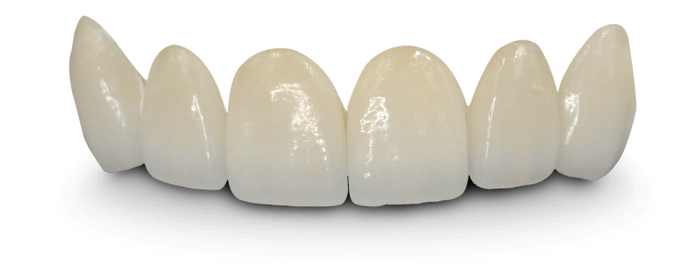 faccette dentali