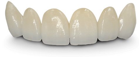 faccette dentali