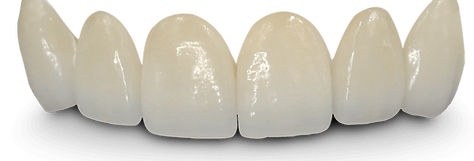 faccette dentali
