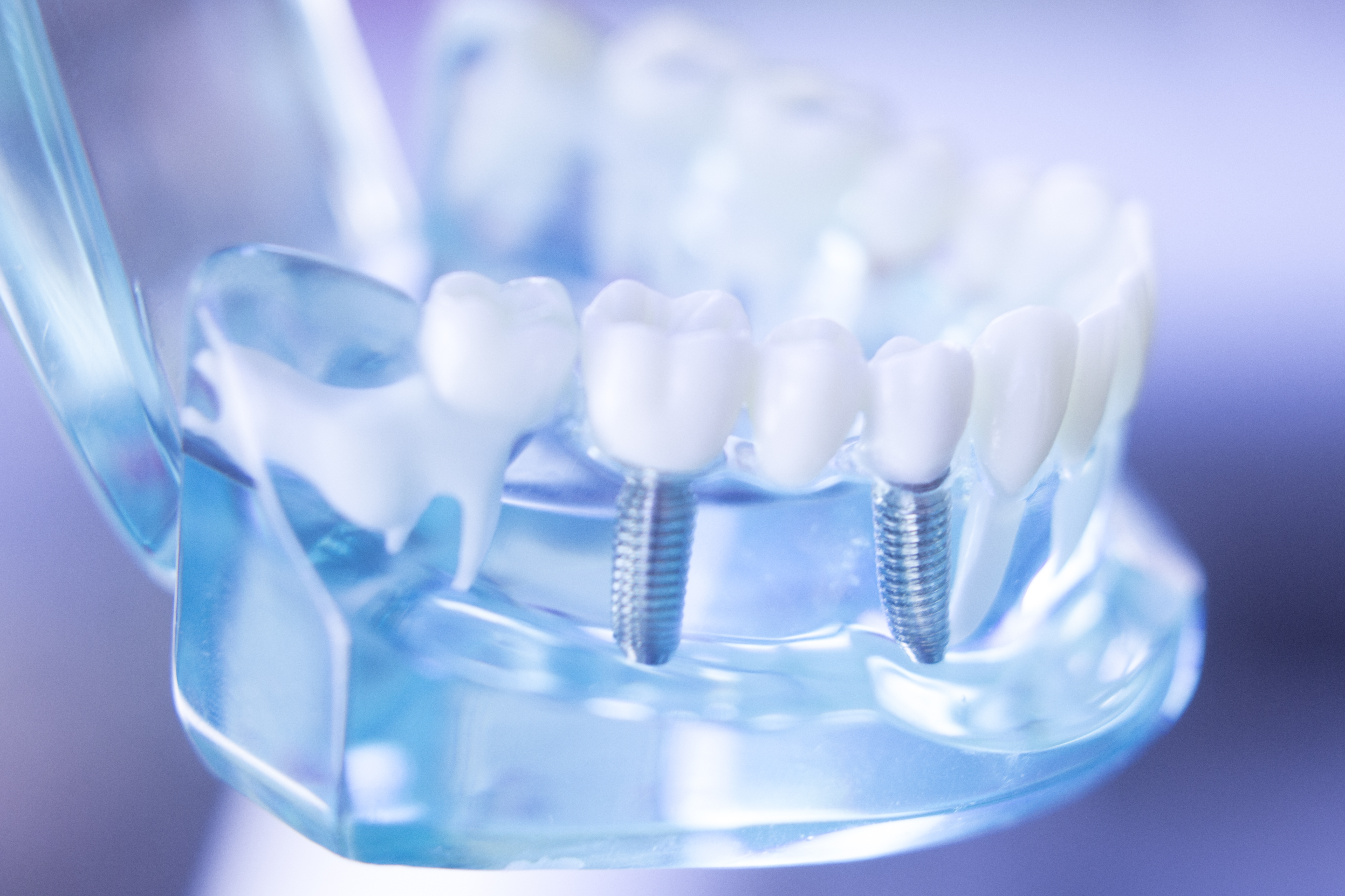 implantologia e impianto dentale
