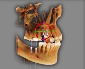 pianificazione implantare rid tiny