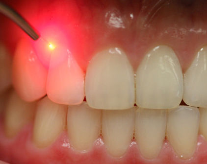 trattamento laser della piorrea