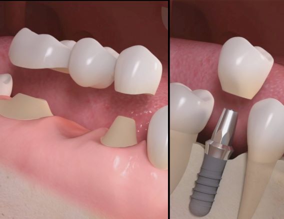 impianto dentale o ponte?