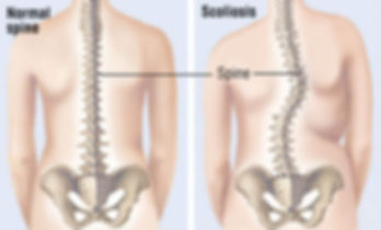 SCOLIOSIS.jpeg