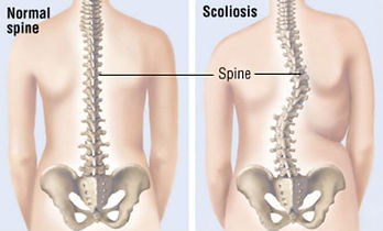 SCOLIOSIS.jpeg