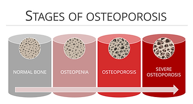 Stages-of-osteoporosis-EN.png