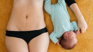 Pelvic Therapy after Cesarean Delivery