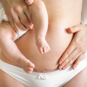 C-Section Recovery 101