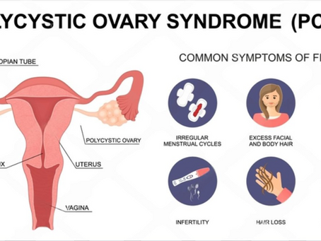 Understanding Polycystic Ovary Syndrome (PCOS): A Complex Hormonal Disorder Affecting Women’s Health