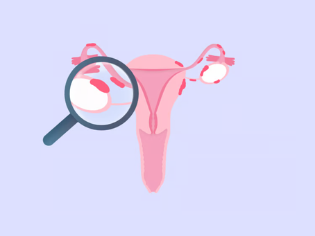 Endometriosis: The Hidden Condition Affecting Millions of Women