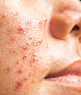 cystic-acne-trestment-specialist-near-me-everett-wa