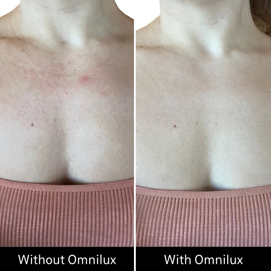 Thumbnail: Omnilux Contour Neck & Décolleté 