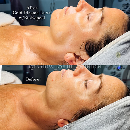 biorepeel-chemical-peel-everett-seattle