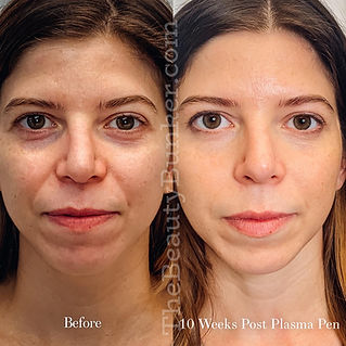 plasma-face-lift-brow-lift