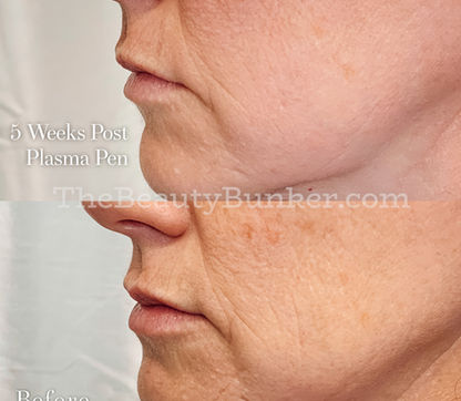 plasma-pen-jowls-chin-augmentation-lipo.jpeg
