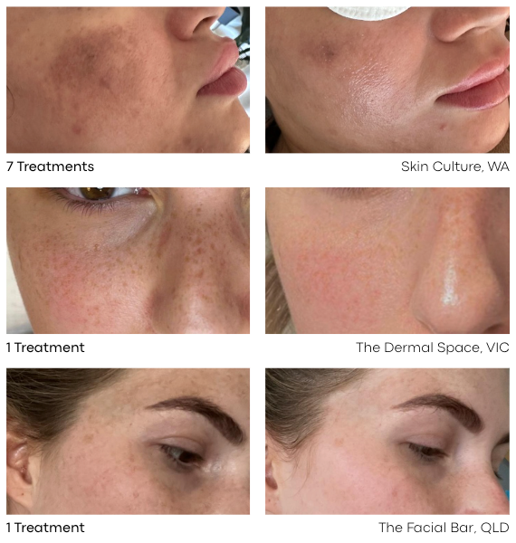 Pigmentation and melasma treatment before and afters using Larimedical Peels.