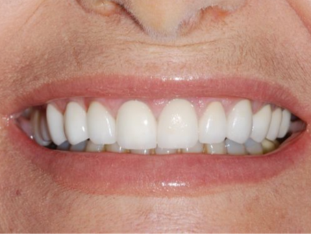 Full Mouth Rehabilitation: Who It’s For and What the Process Includes (Jerusalem Guide)
