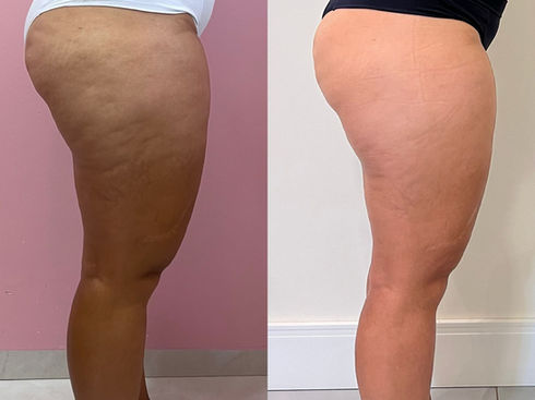 Tratamento para Celulite