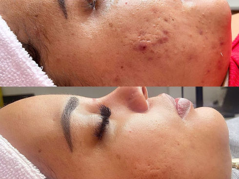 Tratamento para Acne