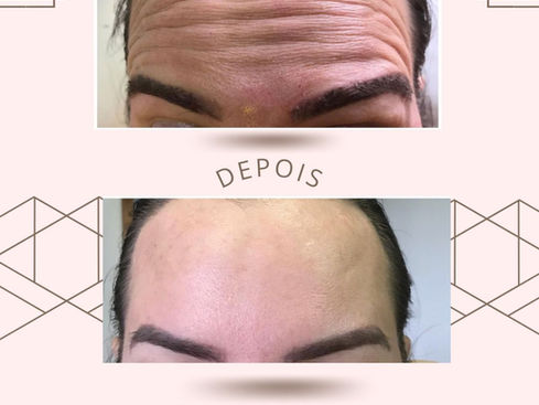 Botox