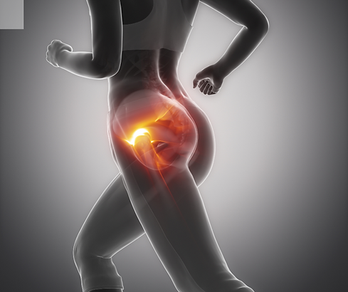 hip bursitis pain.png
